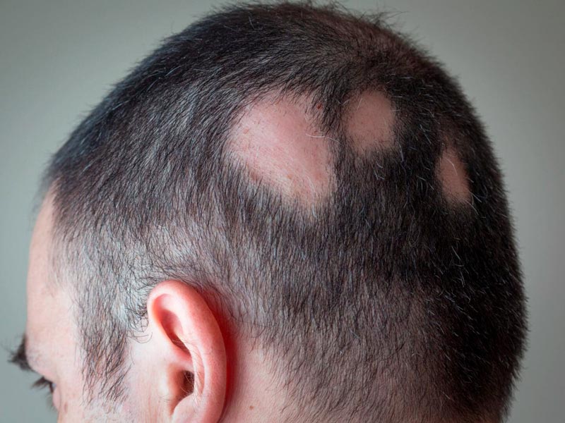 Alopecia