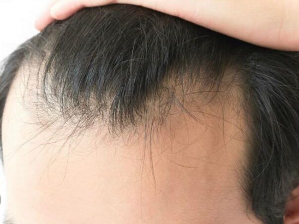 Alopecia