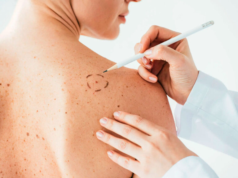 Lee más sobre el artículo Cánceres de piel más frecuentes: Carcinoma Basocelular y Espinocelular