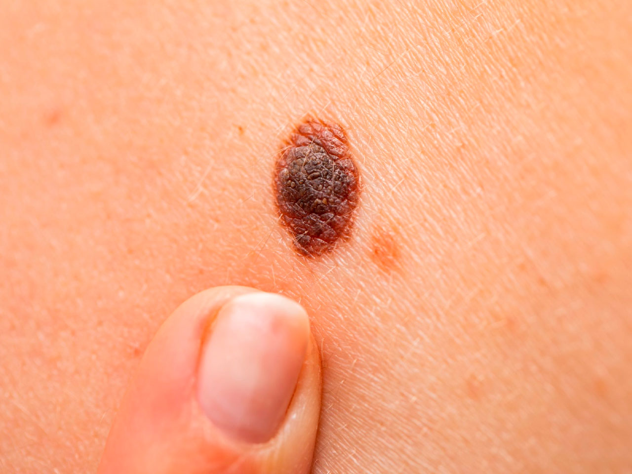 En este momento estás viendo Melanoma y su ABC: Identifica los signos de alerta en tu piel